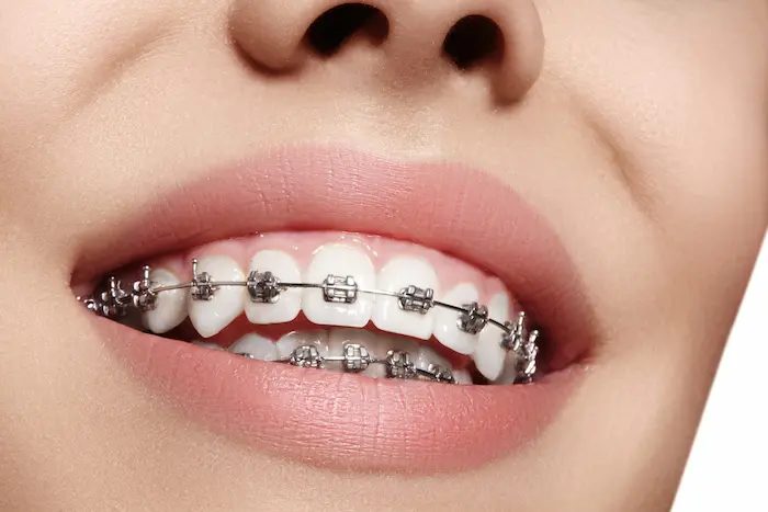 دندان های ارتودنسی شده یک خانم با مینی پلیت 25645