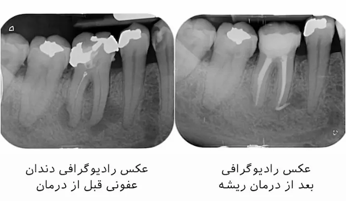 عکس دندان قبل و بعد از عصب کشی 52632692