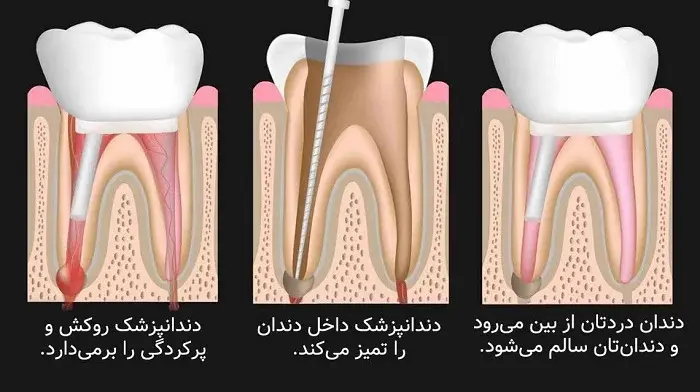 مراحل عصب کشی دندان 56546265