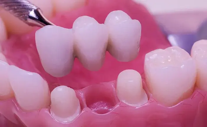 قرارگیری پروتز دندان در لثه 2654153125153