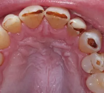 نتیجه تماس و تاثیر اسید معده بر دندان 25664
