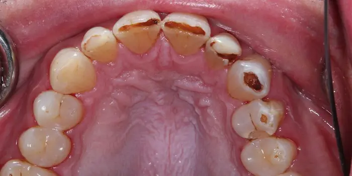 نتیجه تماس و تاثیر اسید معده بر دندان 25664
