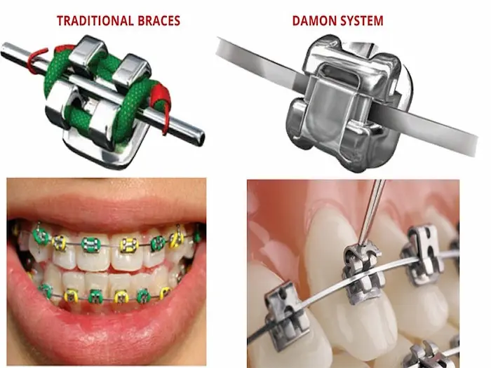 براکت ارتودنسی دیمون 654456