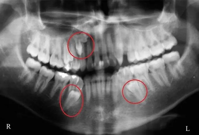 رادیوگرافی دندان های بیمار نشان از داشتن دندان اضافه 546574