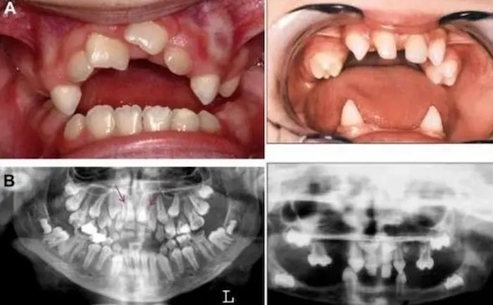 چند نمونه از بیماران مبتلا به دندان اضافه و عکس های رادیوگرافی دندان هایشان 753786573