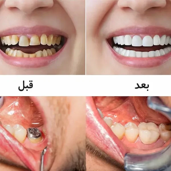 خدمات قبل و بعد از روکش دندان در گرگان توسط تیم گرگان دنتال 8976986565