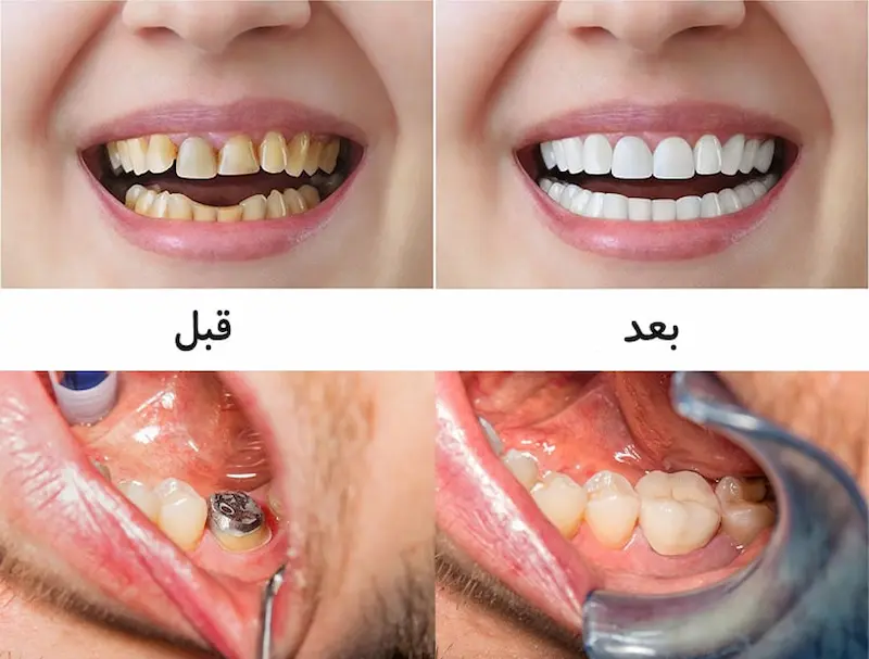 خدمات قبل و بعد از روکش دندان در گرگان توسط تیم گرگان دنتال 8976986565