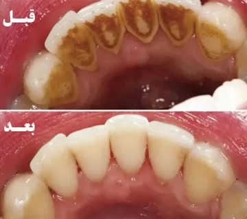 نتیجه قبل و بعد از جرم گیری دندان در گرگان 9875415656