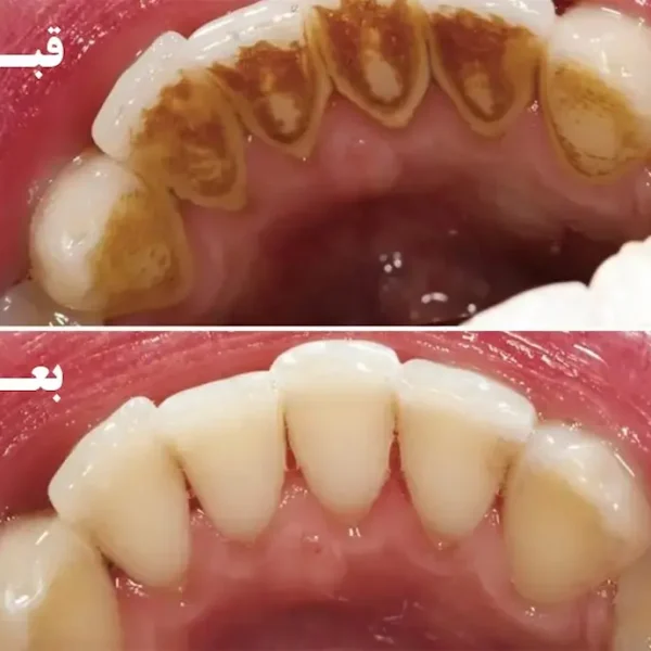 نتیجه قبل و بعد از جرم گیری دندان در گرگان 9875415656