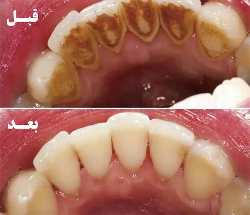 نتیجه قبل و بعد از جرم گیری دندان در گرگان 9875415656